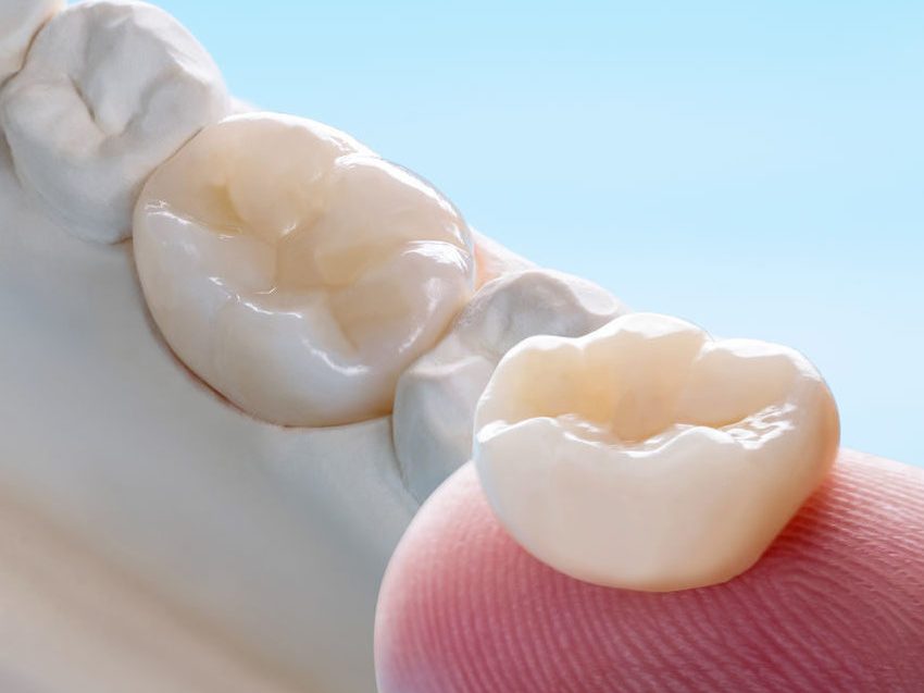 Zahnkronen und Zahnbrücken - Zahnarzt Gloggnitz